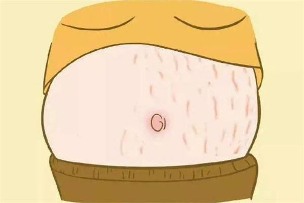 激光去妊娠纹多少钱 激光去妊娠纹价格