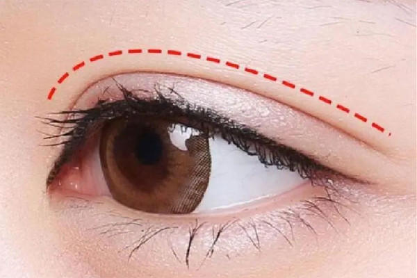 武汉双眼皮埋线哪家医院最好 武汉双眼皮埋线价格