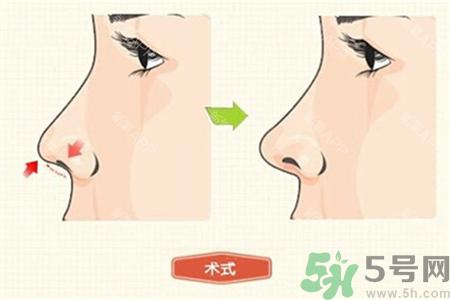 线雕隆鼻是什么?线雕隆鼻可以保持多久?