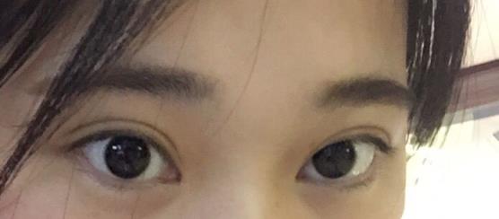 双眼皮失败,什么样的情况下容易造成双眼皮失败!