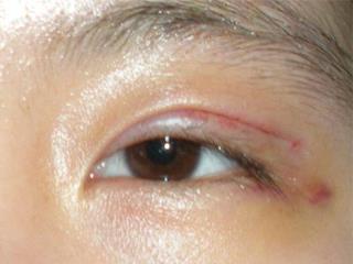 双眼皮失败，什么样的情况下容易造成双眼皮失败！