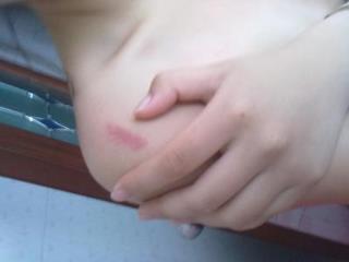 种草莓是什么意思？种草莓怎么消除？