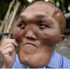 男子怪病似外星人，脸部持续肿大产生异形