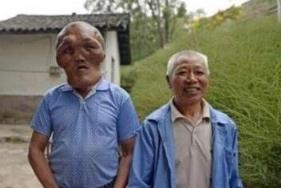 男子怪病似外星人，脸部持续肿大产生异形