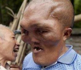 男子怪病似外星人，脸部持续肿大产生异形
