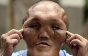 男子怪病似外星人，脸部持续肿大产生异形