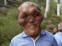 男子怪病似外星人，脸部持续肿大产生异形