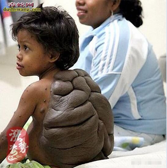 世界上最恐怖的10种人 全球十大恐怖畸形人（真实图片）