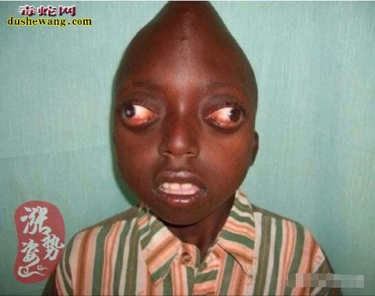 世界上最恐怖的10种人 全球十大恐怖畸形人(真实图片)
