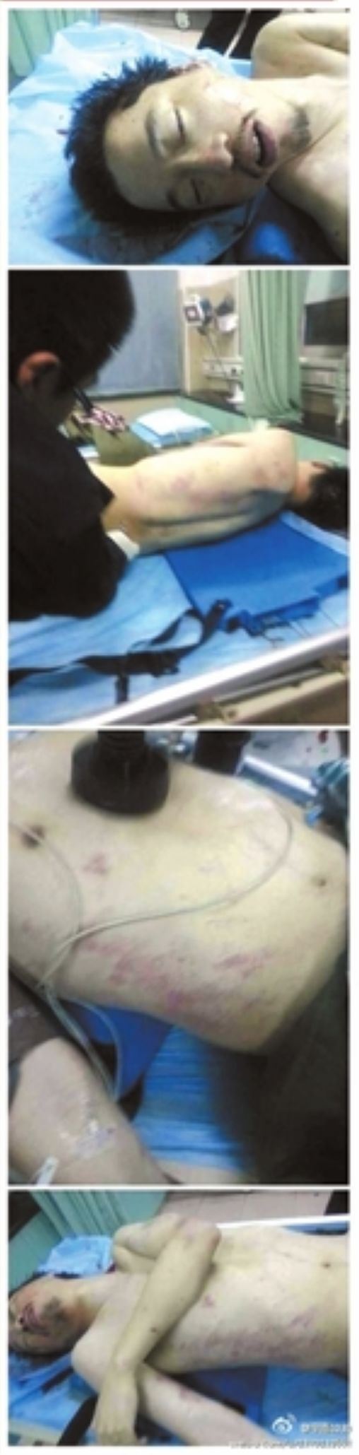 官员双规期意外死亡伤痕累累印证了啥？