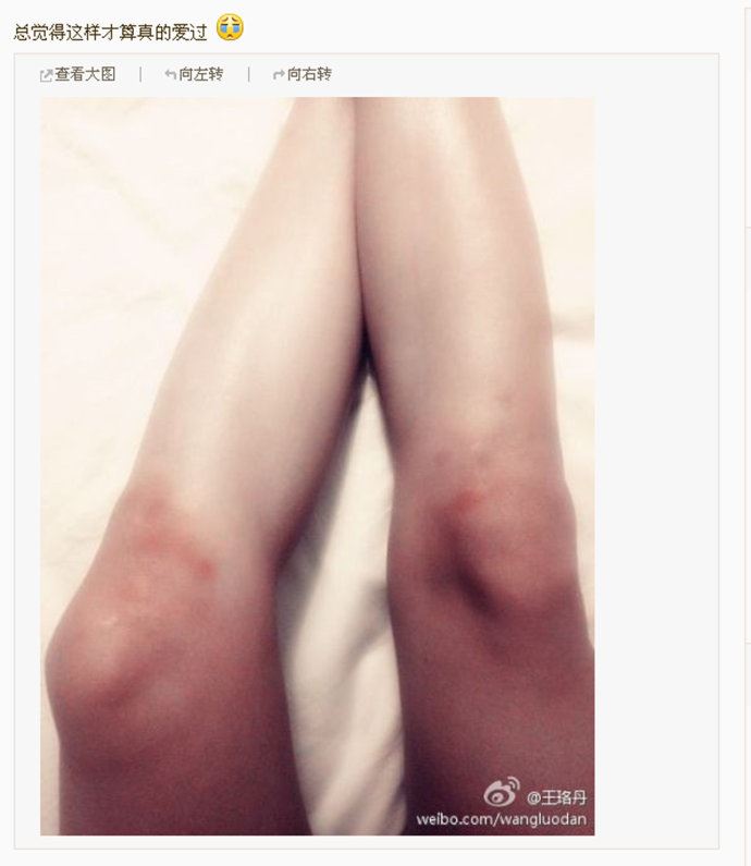 王珞丹微博晒膝盖淤青照与内心单纯有关吗？