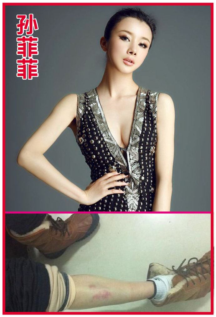 王珞丹微博晒膝盖淤青照与内心单纯有关吗？