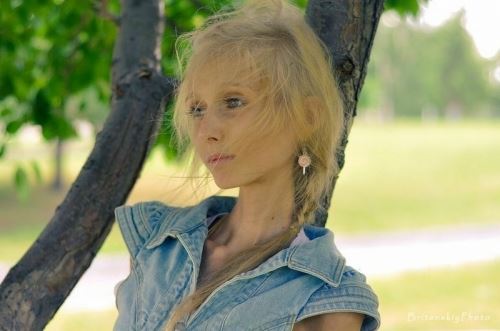 世界上最瘦的人，kseniya bubenko骨瘦如柴仅20公斤(惊悚)