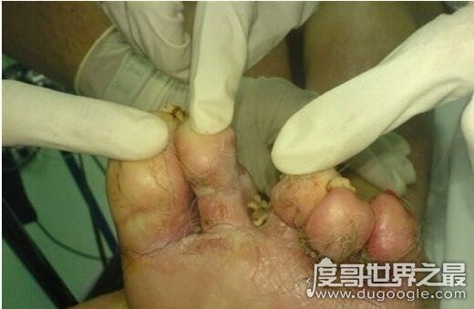 史上最恶心的图片，莲蓬乳/空手指超恶心图片合集(慎入)