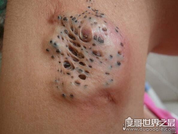 史上最恶心的图片，莲蓬乳/空手指超恶心图片合集(慎入)