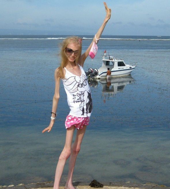 瘦成干尸的少女Kseniya Bubenko，世界上最瘦的人体重仅20公斤（患厌食症）