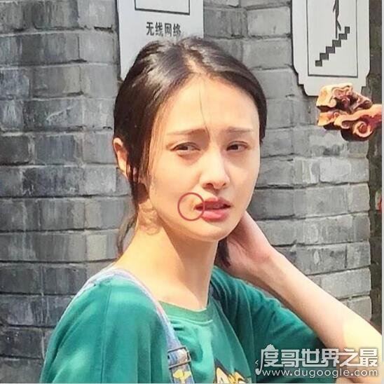 郑爽嘴角伤疤原因,因拍摄电视剧不小心被烫伤(并不是整容失败)