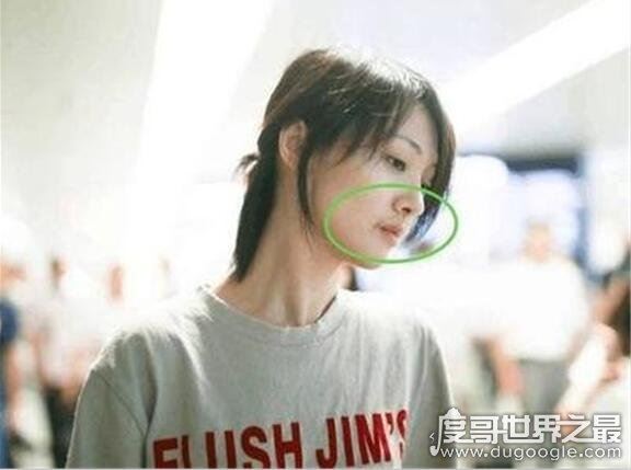 郑爽嘴角伤疤原因，因拍摄电视剧不小心被烫伤(并不是整容失败)