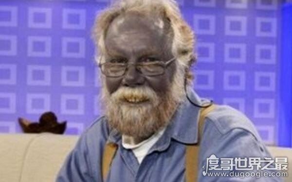 全球十大恐怖怪病,让人心生恐惧(怪病)