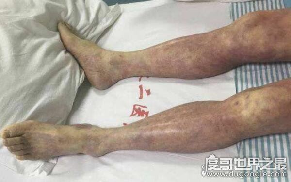 全球十大恐怖怪病,让人心生恐惧(怪病)