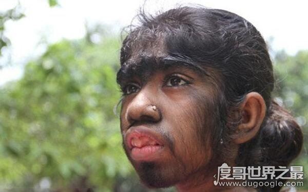 全球十大恐怖怪病，让人心生恐惧（怪病）