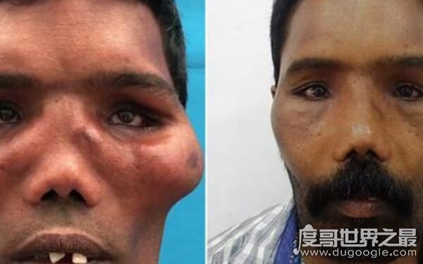 全球十大恐怖怪病，让人心生恐惧（怪病）