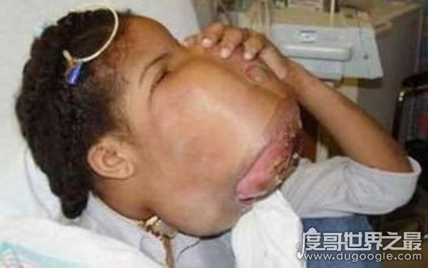 全球十大恐怖怪病，让人心生恐惧（怪病）