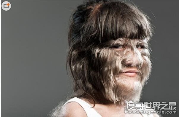 世界上毛最多的人盘点，整个身体99%的部位被毛覆盖(组图)