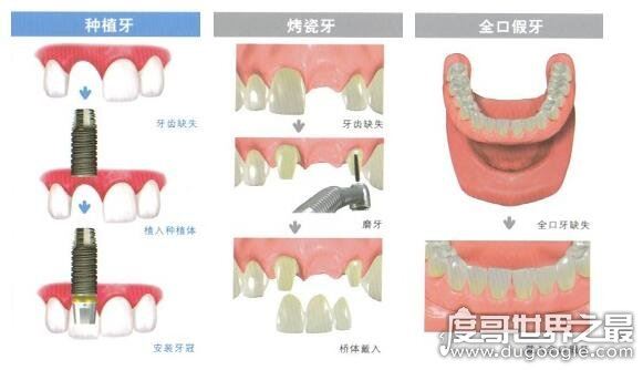 千万不要种植牙的5种情况,有这些情况的人种牙失败率会很高