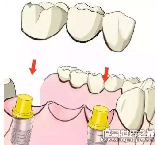 千万不要种植牙的5种情况，有这些情况的人种牙失败率会很高