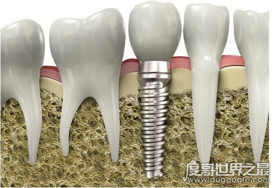 千万不要种植牙的5种情况，有这些情况的人种牙失败率会很高