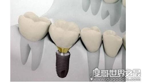 千万不要种植牙的5种情况，有这些情况的人种牙失败率会很高