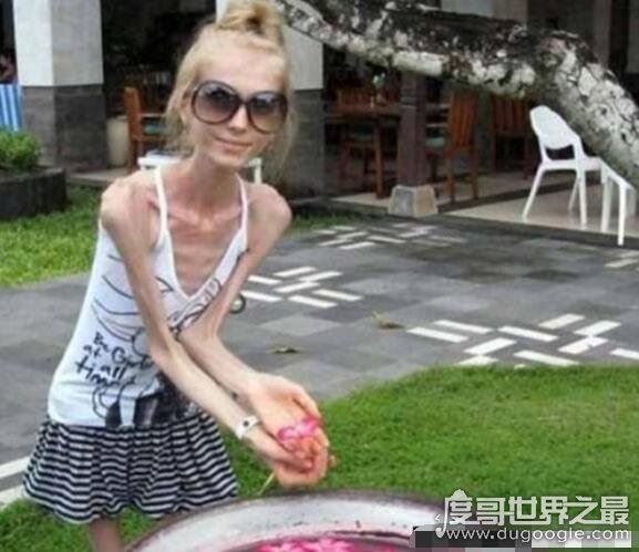 世界上超级瘦的人图片，最瘦的女人40斤/最瘦的男人80斤