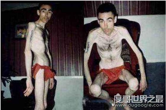 世界上超级瘦的人图片,最瘦的女人40斤/最瘦的男人80斤