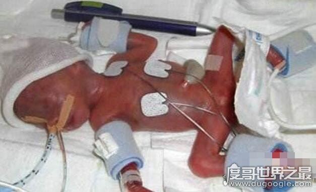 世界上最小的婴儿，阿米利娅·泰勒(仅重280克/长24厘米)