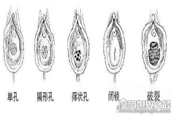 什么是石女,先天无阴道不能性交的女子(18岁没月经就要注意了)