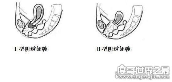什么是石女，先天无阴道不能性交的女子(18岁没月经就要注意了)