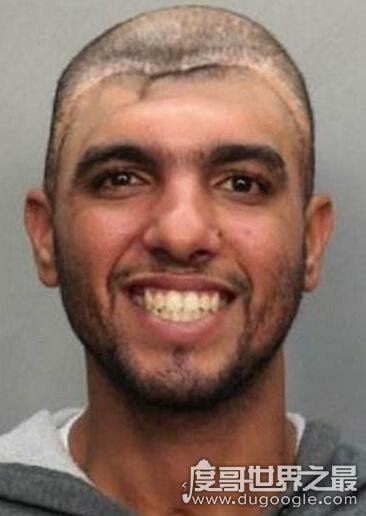 半脑哥卡洛斯不但存活下来，少了半个脑袋的他智商还非常高