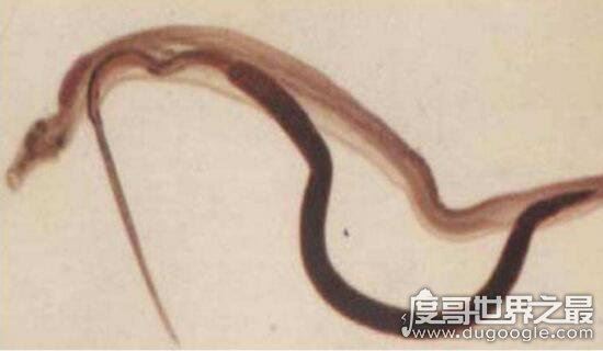 恐怖的吸血虫图片，以人血液为食寄生数十年能致死