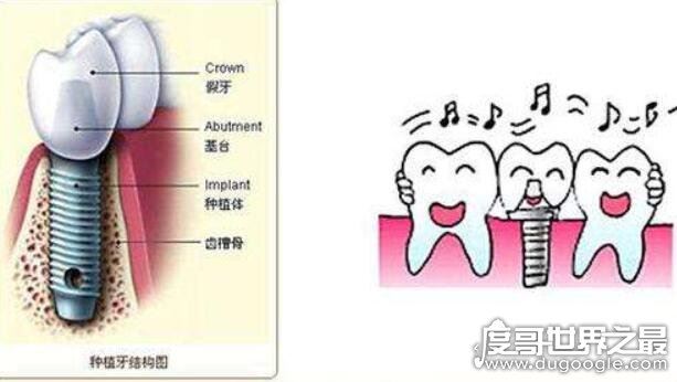 良心医生不建议种植牙的原因，种植牙前这4点你要弄清楚
