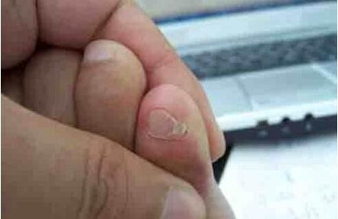 小脚趾甲两瓣是怎么回事,原来有此特征的都是