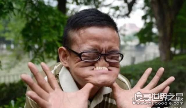 世界上最丑的人，打破吉尼斯最丑世界纪录(无人敢与他比丑)