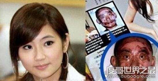 任家萱烧伤图片前后对比,身上全是疤痕(触目惊心)