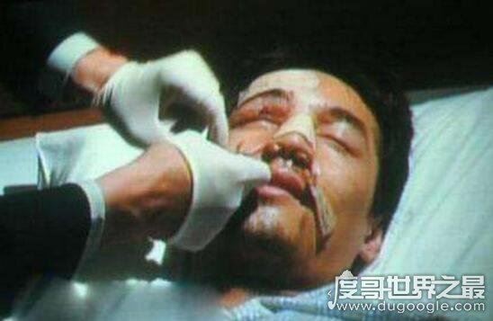 胡歌车祸原因诡异,胡歌车祸前后照片对比遭毁容