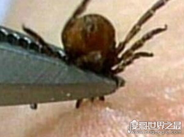 蜱虫叮咬后伤口图片,它的头会钻进人体内(皮肤会红肿一片)