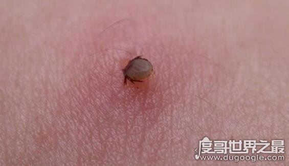蜱虫叮咬后伤口图片，它的头会钻进人体内(皮肤会红肿一片)