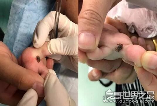 蜱虫叮咬后伤口图片,它的头会钻进人体内(皮肤会红肿一片)