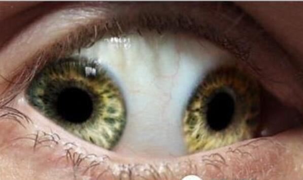 世界上有双瞳的人吗,双瞳孔是真实存在(我国就有不少)