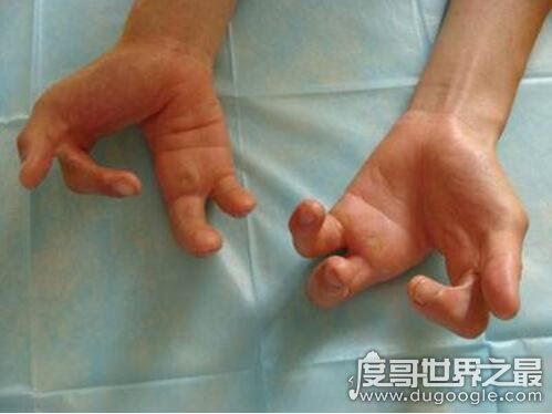 天生畸形的螃蟹手,8岁男童被丢弃三次终被治愈