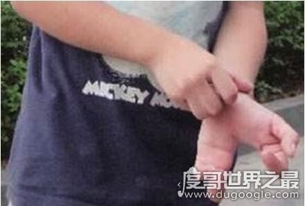 天生畸形的螃蟹手，8岁男童被丢弃三次终被治愈
